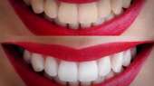 Перейти к объявлению: Отбеливание зубов системой Beyond Polus - акция в Эстет Смайл!
